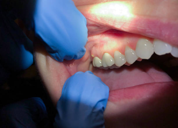 Best Dental Abscess Treatment in De Soto, IA