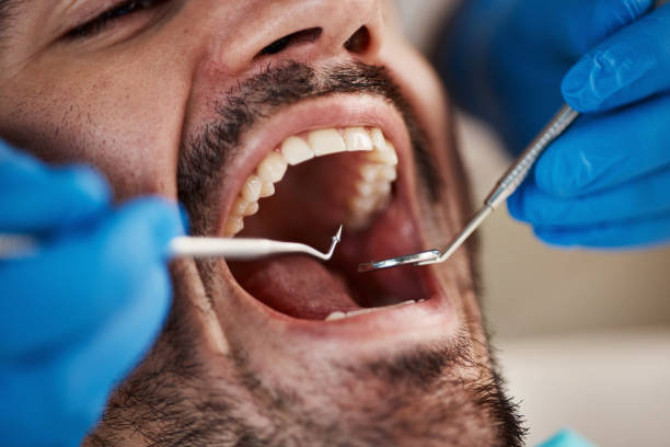 Best Emergency Wisdom Tooth Extraction in De Soto, IA